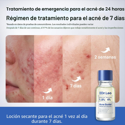 Dr. Leo Suero Secante para el Acné