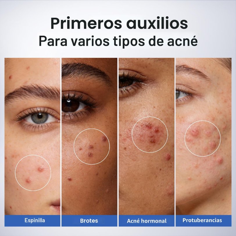 Dr. Leo Suero Secante para el Acné